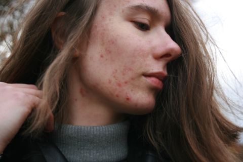 acne tardiva beautycologa
