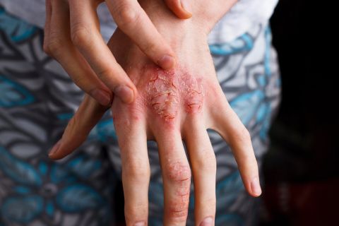 dermatite atopica beautycologa a