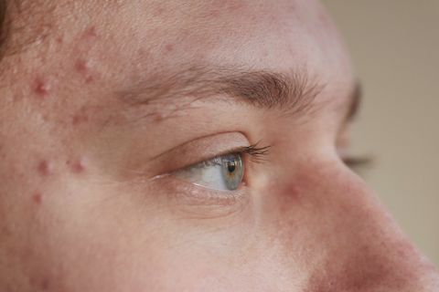 brufoli spot treatment beautycologa