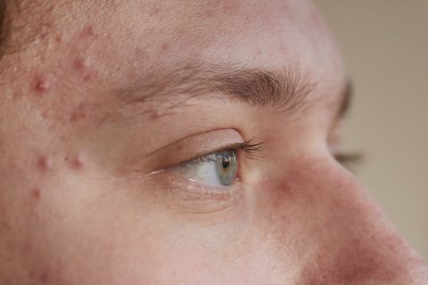 brufoli spot treatment beautycologa