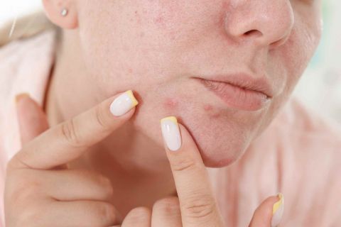 schiacciare brufoli beautycology